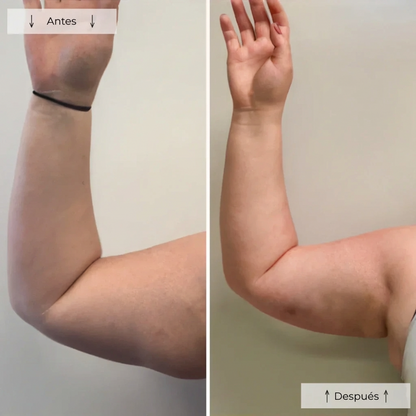 Terapia de luz roja: Elimina la celulitis en 28 días